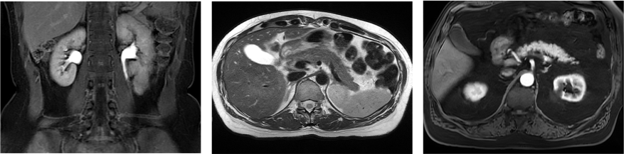 MR Abdomen snimci